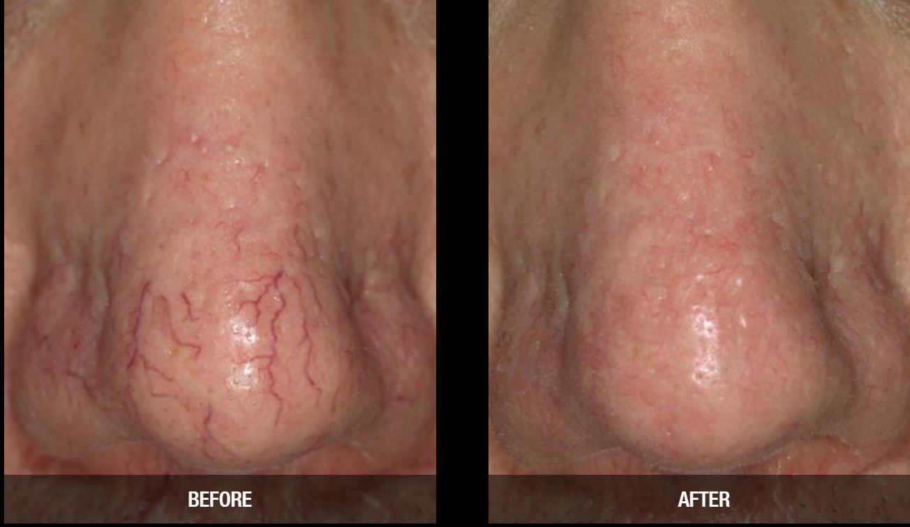 ✅Syneron Candela Pro Series HP Compatible For Gentle Pro Series GentleMax Pro